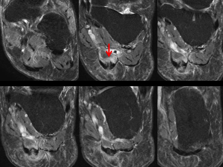 Figure 3 for case central bundle of plantar fascia ( RID3231 )
